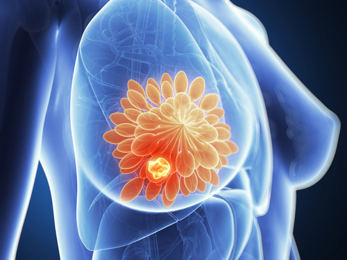 راه های شناسایی سرطان سینه